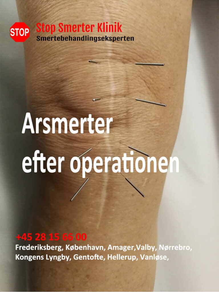 Arsmerter efter operationen i Frederiksberg